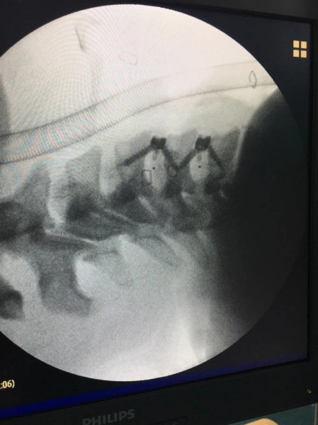 TITANOPEEK STAND ALONE CERVICAL CAGE SYSTEM - Img 5