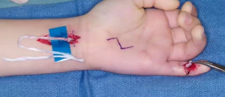 Universal Tendon Spacer U.T.S. – Distanțier Tendinos din Silicon pentru Reconstrucția Tendoanelor Flexorilor și Extensorilor - Img 6
