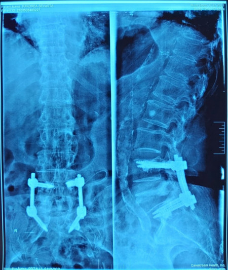 Vesta, Surub din Titan, fenestrat (Osteoporoza,  AP Trauma si Oncologie)