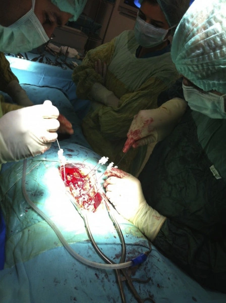 Vesta, Surub din Titan, fenestrat (Osteoporoza,  AP Trauma si Oncologie)