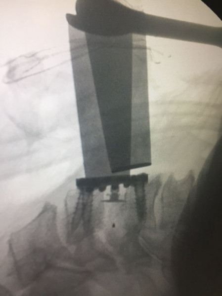 AURA, Suruburi fixare placa cervicala ( AP Trauma)
