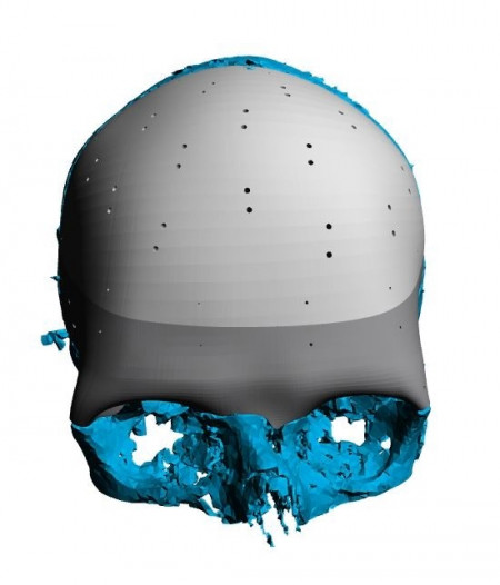 Cranioplasty patient-specific implants - Img 3