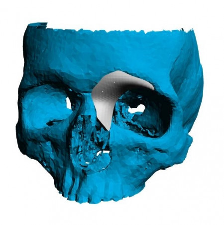 Cranioplasty plate for ENT defects - Img 4