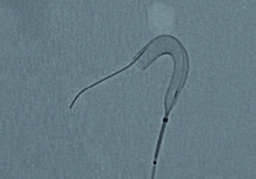 Dispozitiv de embolizare pentru tratamentul anevrismelor cerebrale - DERIVO® 2 - Img 4