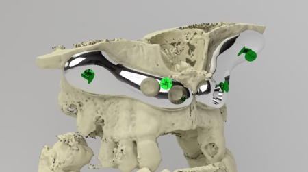 iCMF Ti – Implant Craniomaxilofacial Personalizat din Titan | BoneEasy® - Img 2