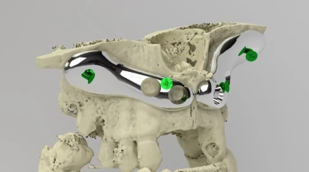 iCMF Ti – Implant Craniomaxilofacial Personalizat din Titan | BoneEasy® - Img 2