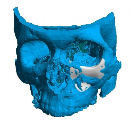 Implant personalizat pentru reconstructia fetei si craniului | 3di Germania - Img 6