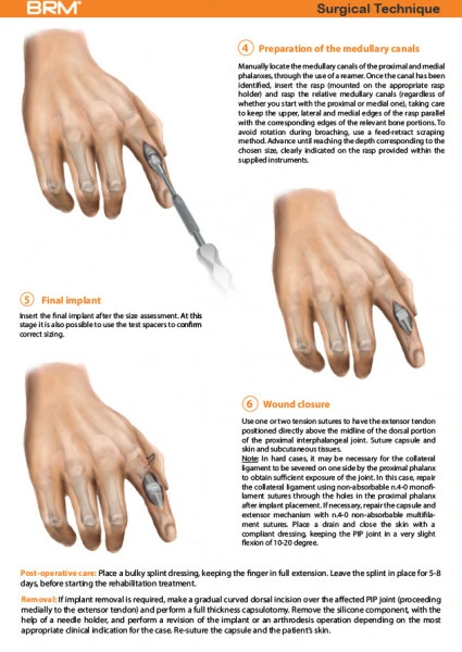 Implant interfalangian PIP din silicon( Chirurgie Plastica, Ortopedie)
