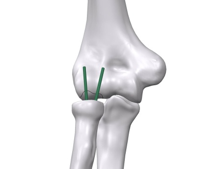 Inion FreedomPin™ – Pin ortopedic bioresorbabil pentru fracturi și osteotomii | Ø1.5–3.2 mm - Img 5