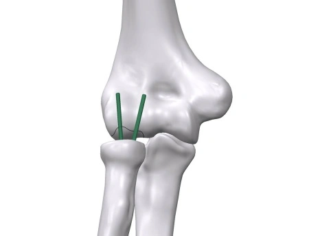 Inion FreedomPin™ – Pin ortopedic bioresorbabil pentru fracturi și osteotomii | Ø1.5–3.2 mm - Img 5