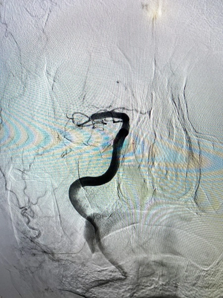 Pictura abstracta: The STROKE ( Accidentul Vascular Cerebral) sau Omul din Copacul Creierului - Img 8