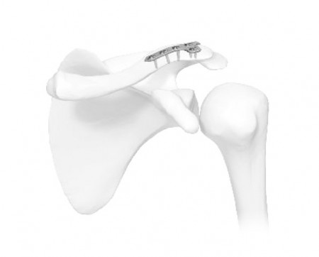 Placă Claviculă Acromioclaviculară – Tratament Dislocări AC | Sistem Vortex