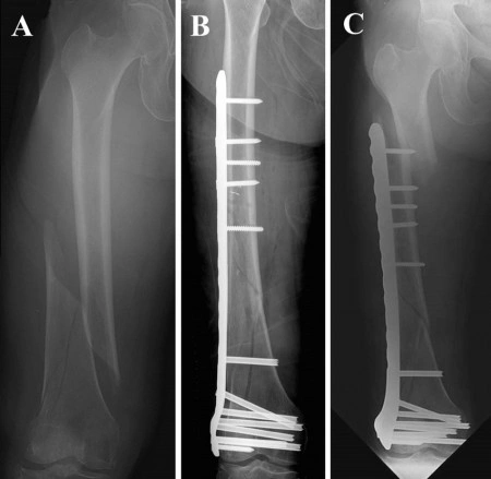 Placa de femur distal poliaxiala pentru osteosinteza fracturii de femur