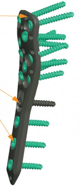 Placa Humerus Proximal poliaxiala pentru osteointeza fracturii de Humerus