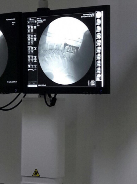 SENTINUS – Mesh Cage pentru Corpectomie Cervicală și Lombară - Img 3