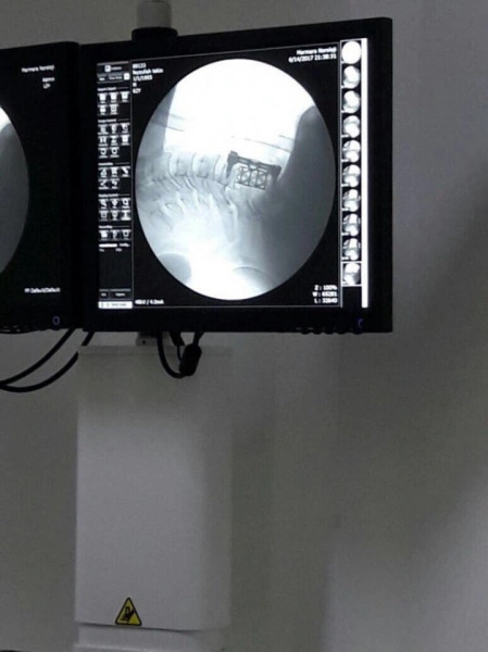SENTINUS – Mesh Cage pentru Corpectomie Cervicală și Lombară - Img 3