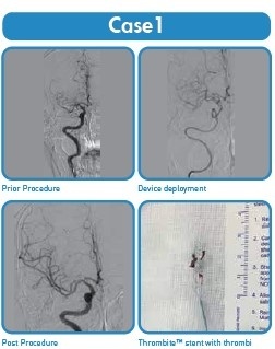 THROMBITE™ – Stent Retriever pentru Trombectomie | Zylox-Tonbridge Medical - Img 4
