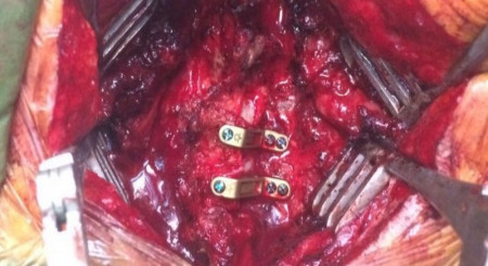 ULTIO LAMINOPLASTY POSTERIOR CERVICAL SPINAL FIXATION SYSTEM - Img 2