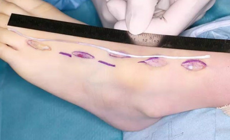 Universal Tendon Spacer U.T.S. – Distanțier Tendinos din Silicon pentru Reconstrucția Tendoanelor Flexorilor și Extensorilor - Img 7
