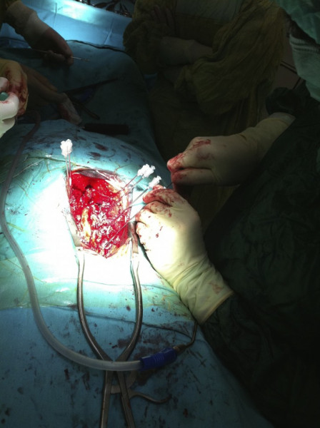 Vesta, Surub din Titan, fenestrat (Osteoporoza,  AP Trauma si Oncologie)
