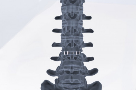 ZELOS – Cage Lombar PLIF din PEEK sau Titan | Fuziune Vertebrală Posterioară - Img 2