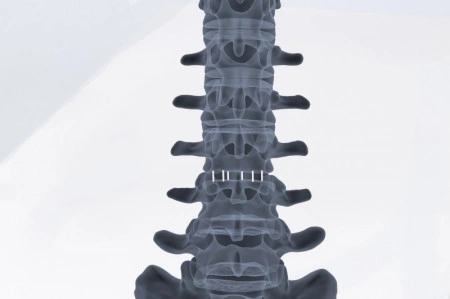 ZELOS – Cage Lombar PLIF din PEEK sau Titan | Fuziune Vertebrală Posterioară - Img 2