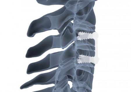 AURA ANTERIOR CERVICAL PLATE SYSTEM - Img 2