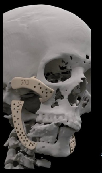 Implant personalizat pentru maxilar, subperiostal – Implantize Compact (Titanium / PEEK) (BoneEasy) - Img 5