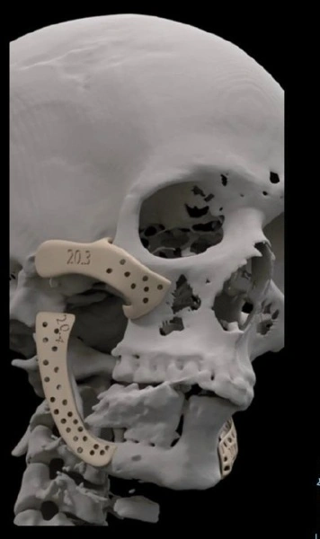 Implant personalizat pentru maxilar, subperiostal – Implantize Compact (Titanium / PEEK) (BoneEasy) - Img 5