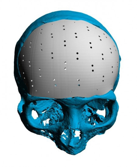 Placa (Cranioplastie), defecte craniene - Img 4