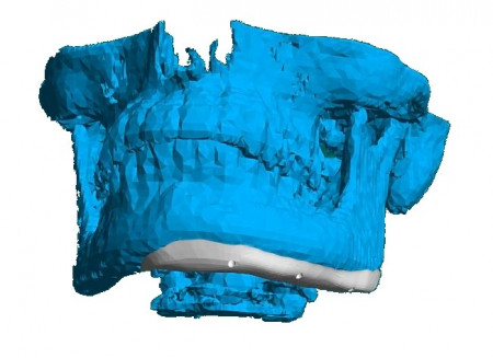 Placă Cranioplastie Personalizată 3D – Implant pentru Defecte BMF | 3di Germania - Img 7