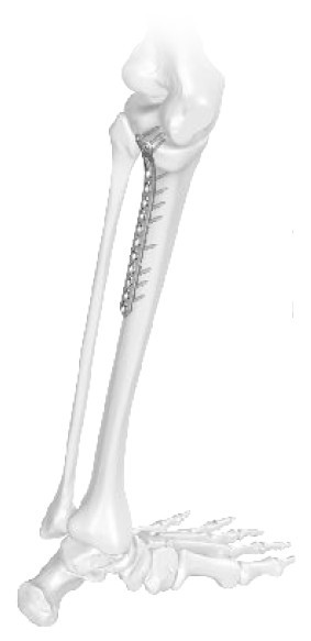 Placă de Tibie Proximală L – Tratament Fracturi Condil Lateral | Sistem Vortex