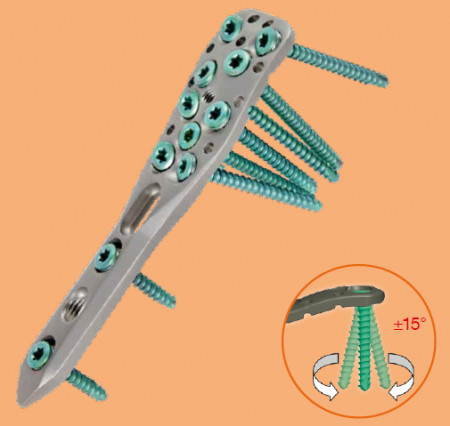 Placa Humerus Proximal poliaxiala pentru osteointeza fracturii de Humerus