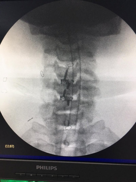 TITANOPEEK - Cage Vertebral Cervical cu suruburi de prindere si profil anatomic