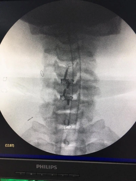 TITANOPEEK - Cage Vertebral Cervical cu suruburi de prindere si profil anatomic