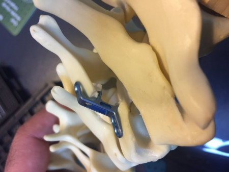 ULTIO LAMINOPLASTY POSTERIOR CERVICAL SPINAL FIXATION SYSTEM - Img 3