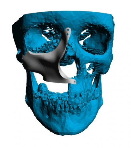 Cranioplasty plate for ENT defects - Img 6