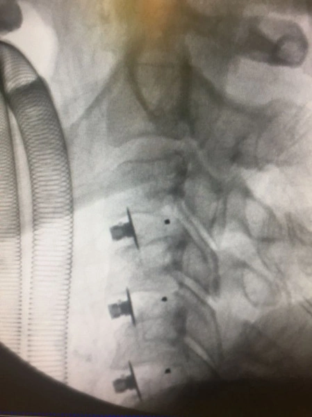 EOS BLADED CERVICAL PEEK CAGE - Img 6