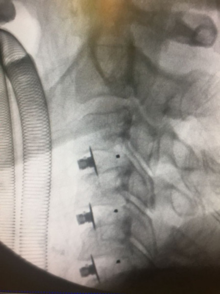 EOS Hybrid – Cage Cervical din PEEK cu Lamă de Fixare | Fuziune ACDF Stabilă - Img 6