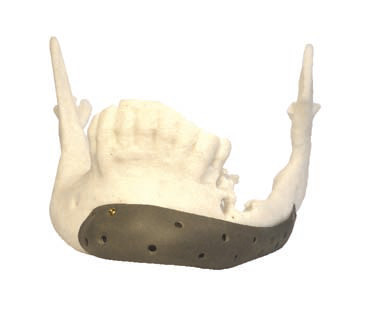 Implant mandibula Titan PSI Enlife Solutions