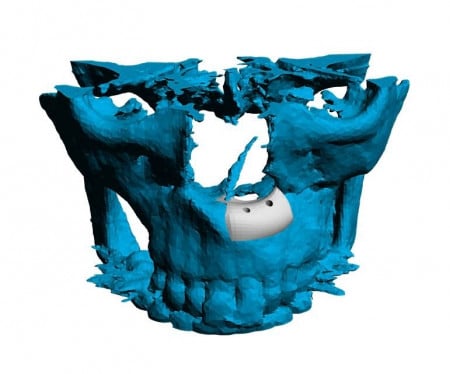 Implant personalizat pentru reconstructia fetei si craniului | 3di Germania - Img 8