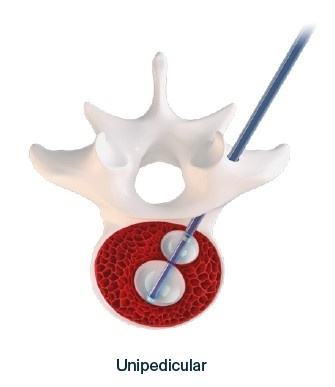 Kit de Kyphoplastie Unipediculară | Reconstrucție Vertebrală Joline | AP Trauma - Img 3