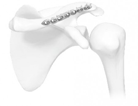 Placă Claviculă în S – Fixare Poliaxială Anatomică | Sistem Vortex