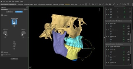 Software pentru planificare chirurgicală cranio-maxilo-facială, chirurgie ortognată – Mimics Enlight CMF (Materialise) - Img 3