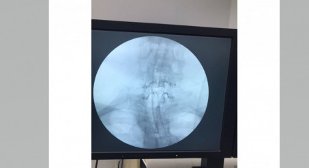 ULTIO LAMINOPLASTY POSTERIOR CERVICAL SPINAL FIXATION SYSTEM - Img 4