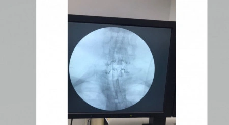 ULTIO LAMINOPLASTY POSTERIOR CERVICAL SPINAL FIXATION SYSTEM - Img 4