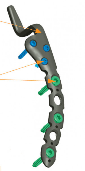 Placa acromioclaviculara poliaxiala pentru osteointeza fracturii de clavicula