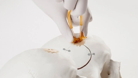 Cranial COVER® – Acoperire Estetică și Sigură pentru Găurile de Trepanație | Neos Surgery - Img 3