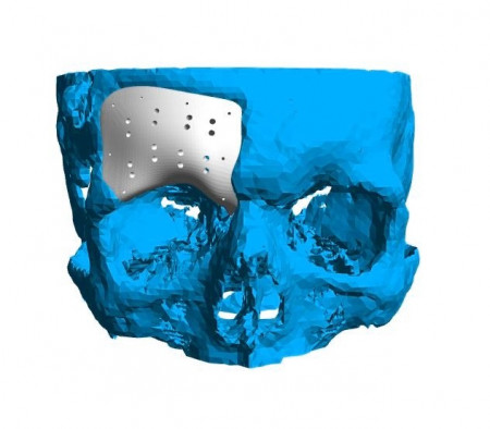 Cranioplasty plate for ENT defects - Img 7