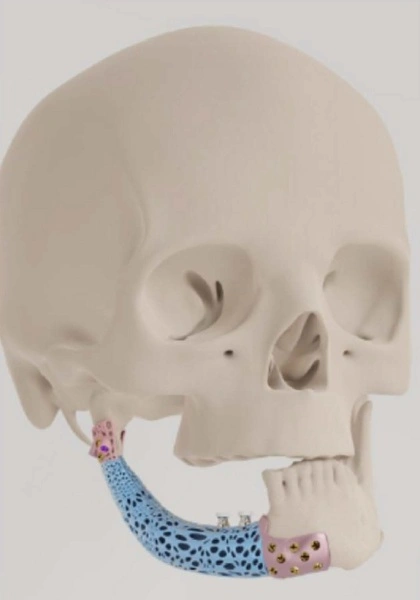 Endoproteză Temporo-Mandibulară TMJ Specifică Pacientului – Soluție 3D Personalizată (Dynajoint™ – BoneEasy) - Img 2